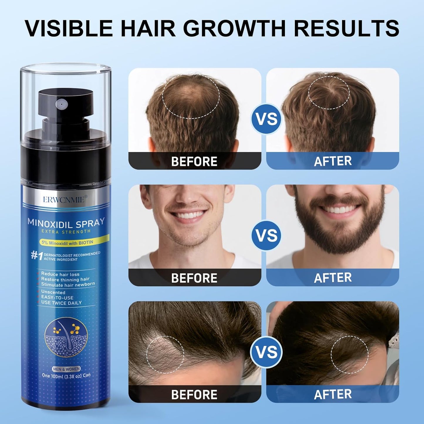 5% Minoxidil Spray for Men and Women-7 pack, Infused with Biotin, Beard Growth, Extra Strength Treatment to Combat Hair Loss and Thinning, and Fuller Hair & Beard (11 Month Supply, Extra Strength)